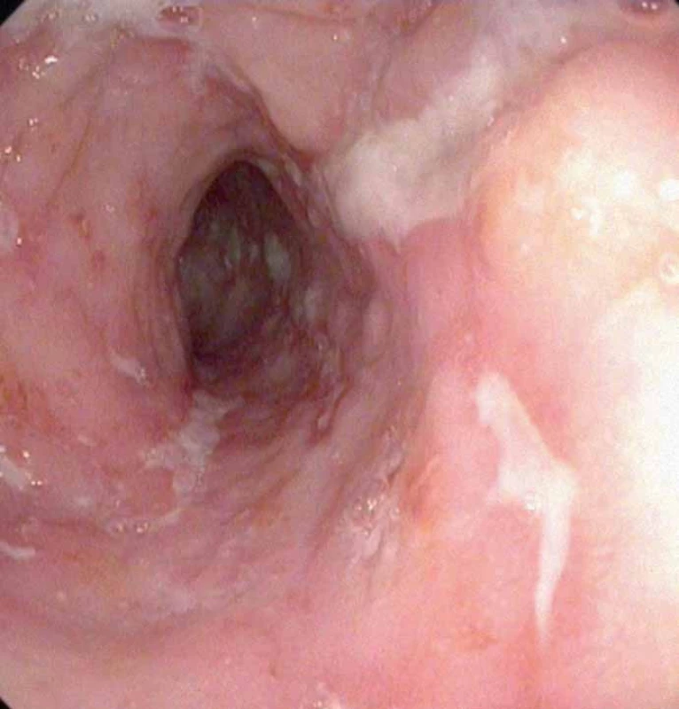 Obraz aktivní IBD (Crohnova nemoc).