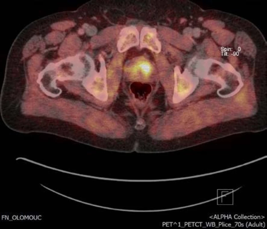 Obr. 3. Ložisko v levém laloku na 18-F-fluorocholin PET/CT příčný řez
Fig. 3. Focus of the tumor in left anterior zone of the prostate on 18F-fluorocholine PET/CT transversal section