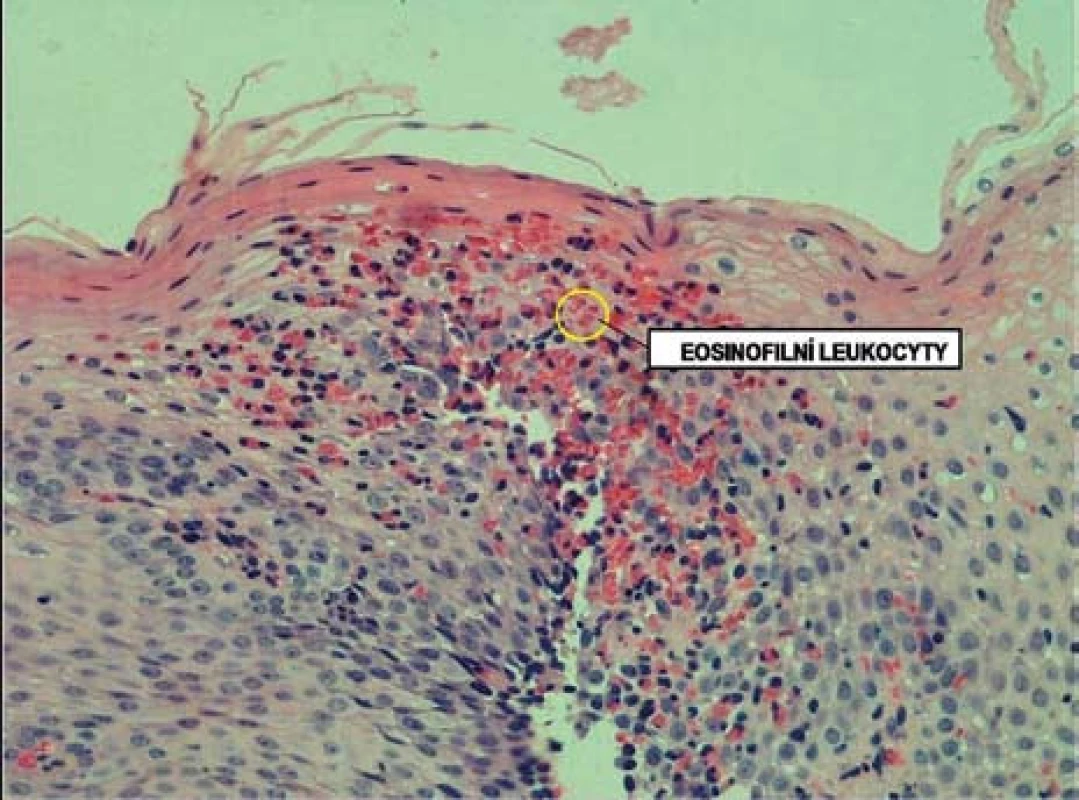 Histologický obraz infiltrace sliznice jícnu eozinofily.
Fig. 6. Histological image of esophageal infiltration by eosinophils.