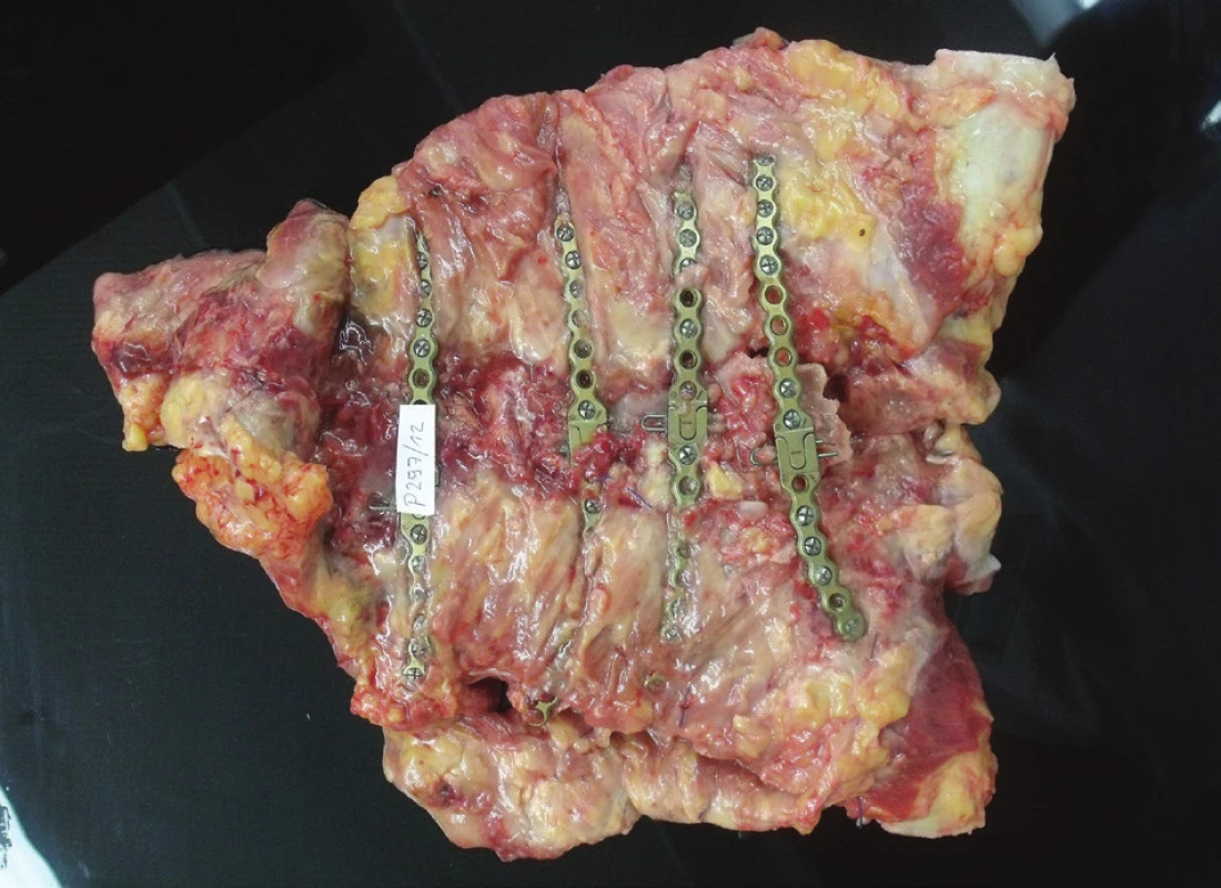 Biopsie hrudní stěny, pohled z horní (pektorální) strany
Fig. 4: Biopsy of the chest wall; view from the upper (pectoral) side