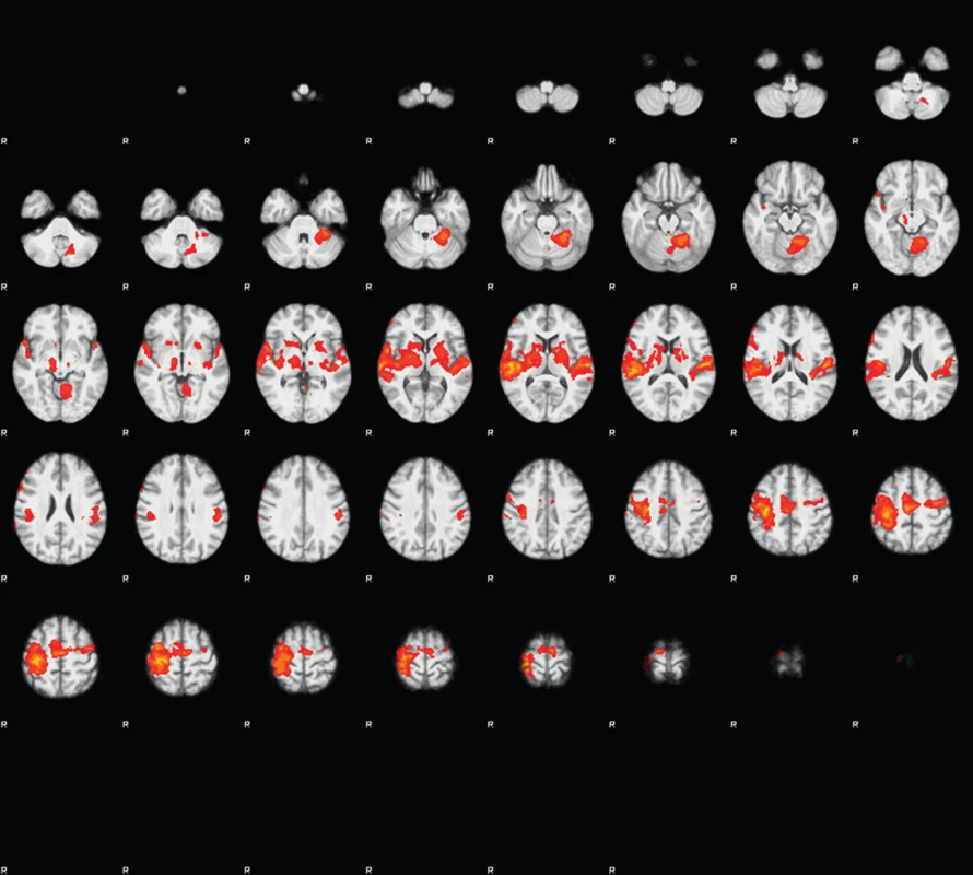 Průměrné skupinové aktivace ve fMRI mozku při pohybu levým zápěstím, před operací krční páteře (Pozadí − zprůměrované T1-vážené obrazy s vysokým rozlišením (sekvence &gt;MPRAGE); popředí − statistické Z mapy − červená (minimum), žlutá (maximum).
Fig. 1: Analysis of mean group effects in brain fMRI during movement of left wrists, before surgery (Background - T1-weighted scans with high resolution (sequences &gt;MPRAGE). Picture - statistical Z-maps -red (minimum), yellow (maximum).