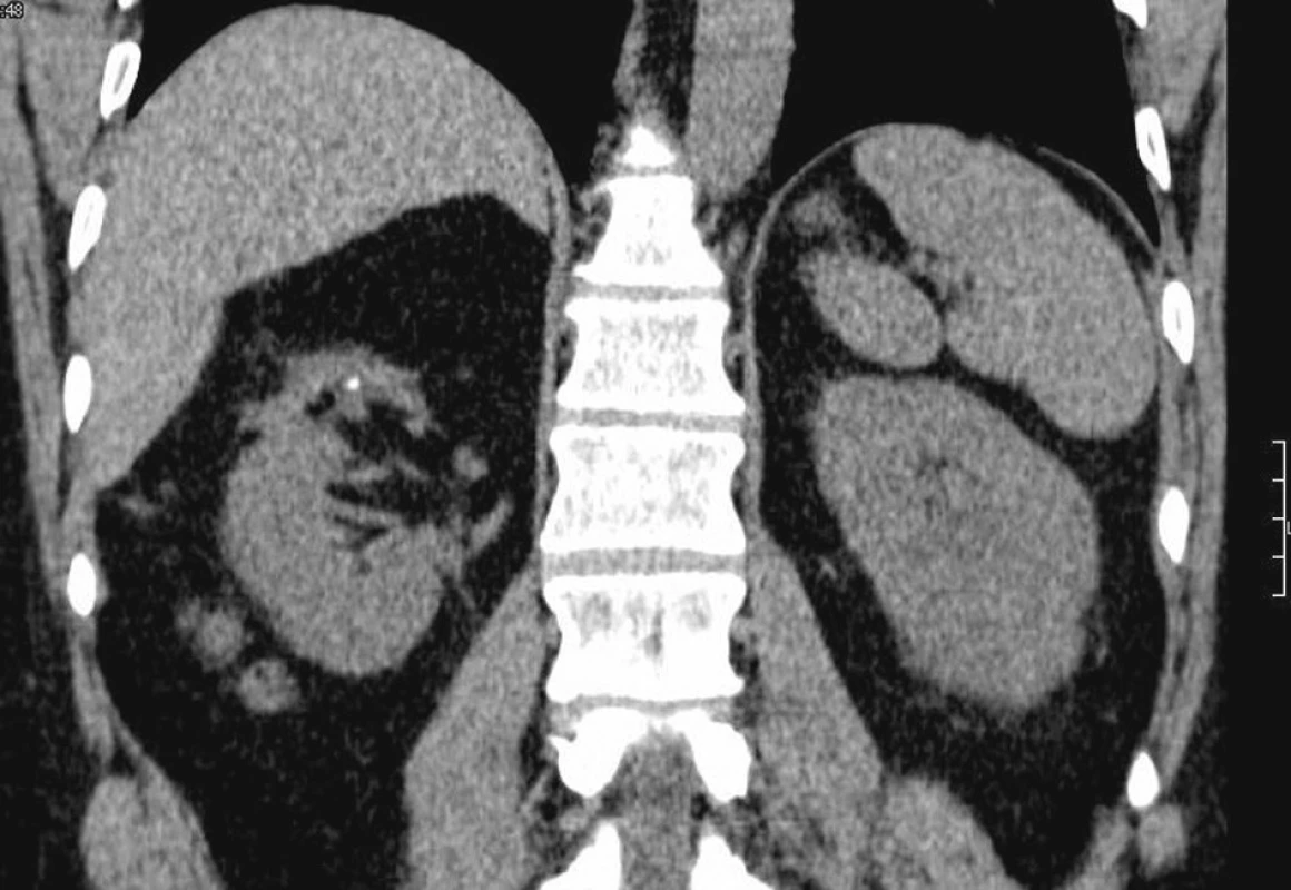 Na CT tangenciálnom skene vidieť fibrózne zmeny v oblasti horného pólu pravej obličky s kalcifikátom a deformáciou kontúry obličky, ktoré vznikli po predoperačnej embolizácii hornej pólovej renálnej artérie.
Fig. 6. A CT tangential scan depicts fibrous changes in the superior pole of the right kidney and its outline deformity, resulting from preoperative embolization of the superior polar renal artery.