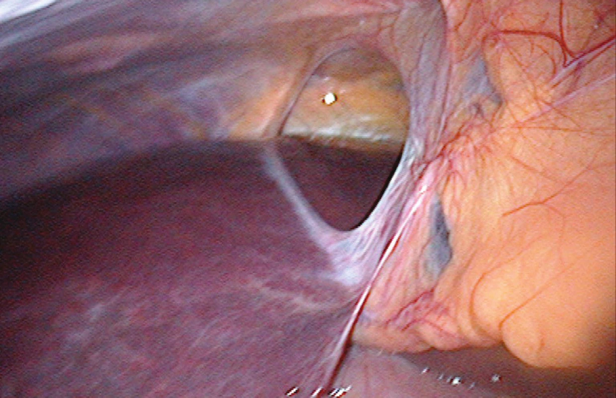 Defekt v ligamentum falciforme hepatis (peroperační snímek)
Fig. 2: The falciform ligament defect (perioperative photo)