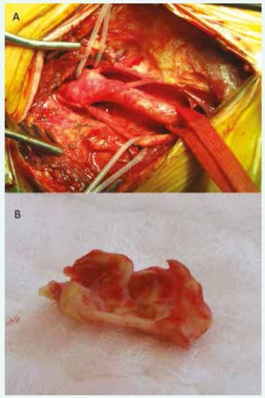 Ilustrativní fotografie z průběhu karotické endarterektomie (A) a následně odstraněného aterosklerotického plátu (B).
