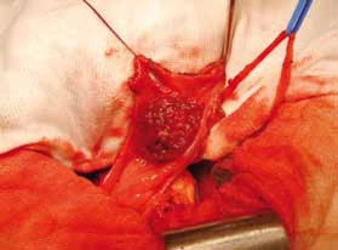 Peroperační nález – tumor lokalizovaný ve vrcholu měchýře
Fig. 2. Intraoperative finding – tumor localized in the bladder dome