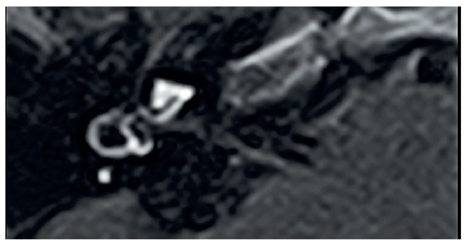 MR, axiální projekce, T1 sekvence, FLAIR, rozšíření endolymfatického prostoru vpravo v oblasti vestibula.