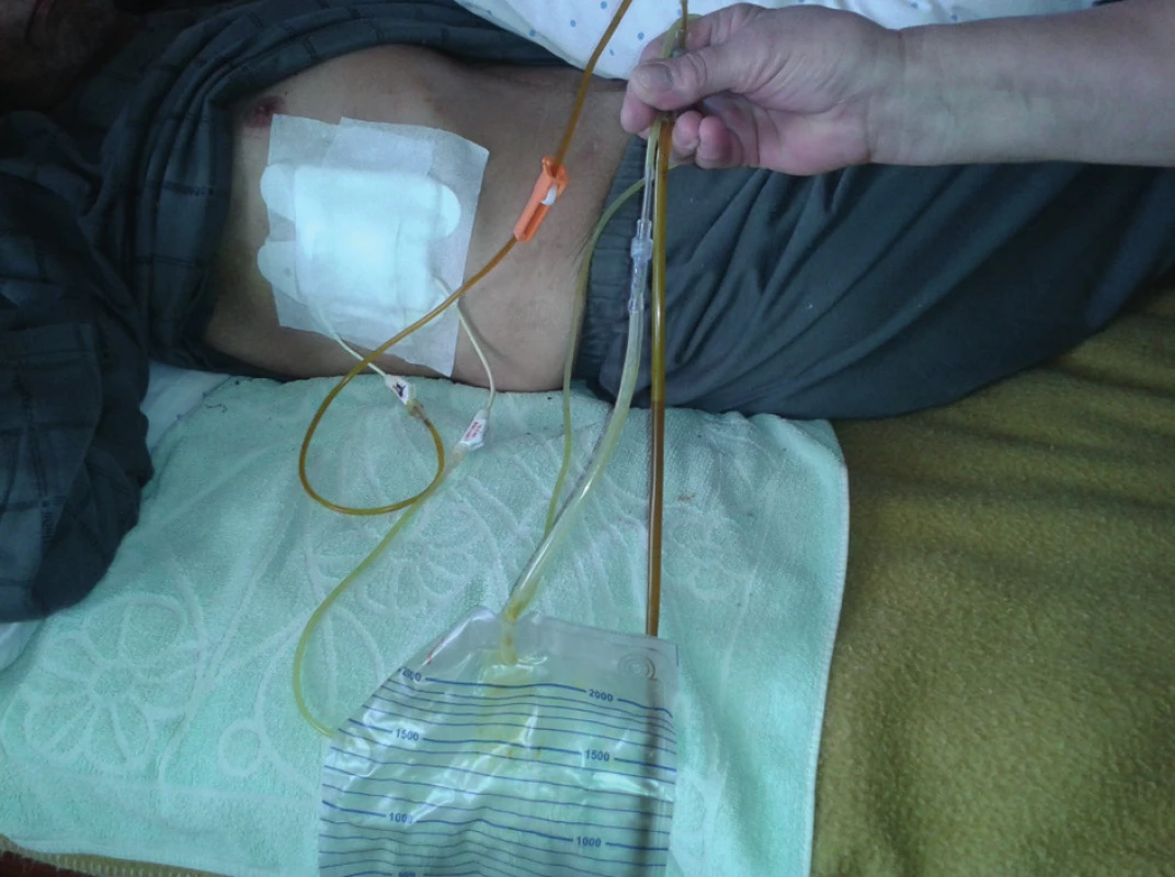 Improvizované spojenia medzi drenážnymi hadičkami zabraňujúce kvalitnému odtoku žlče
Fig. 10: Temporary connections between drainage tubes impeding normal bile flow
