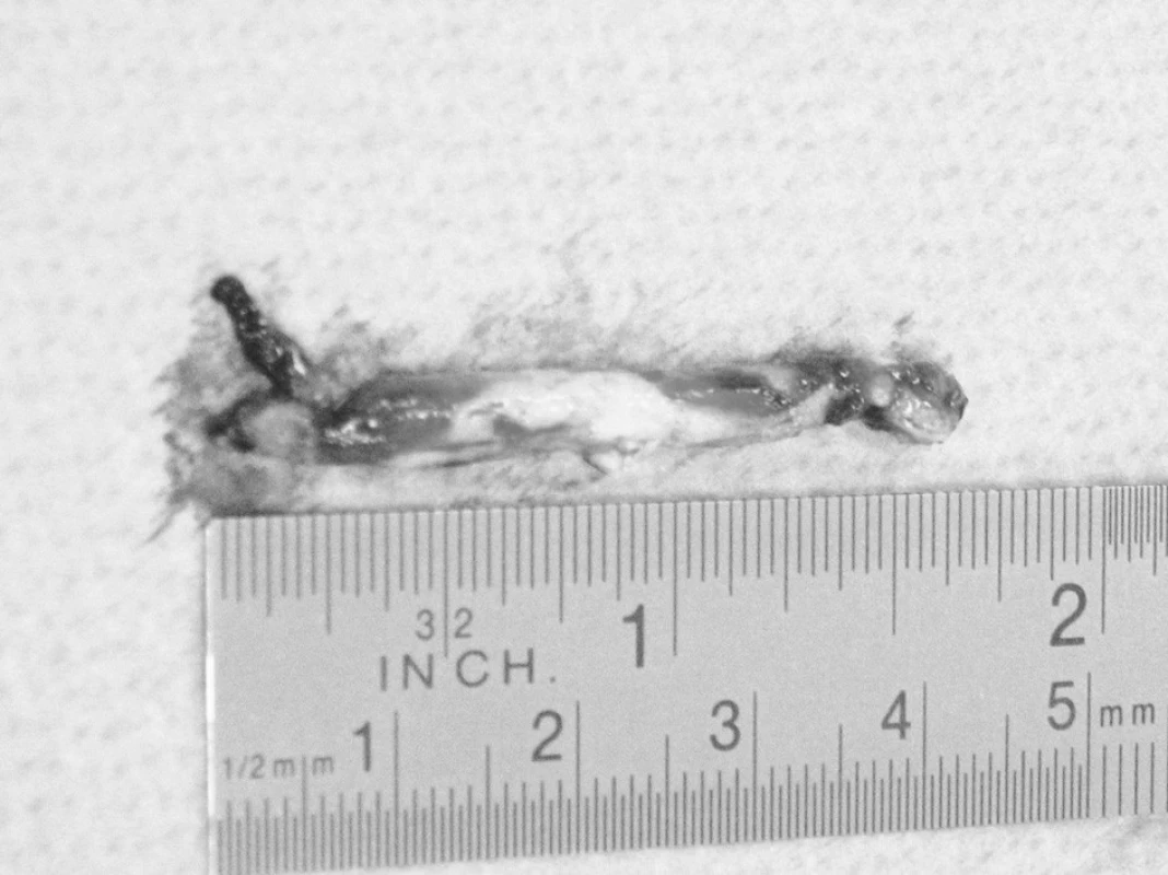 Fotografie vmetku tkáňového lepidla vytaženého z arteriotomie na arteria poplitea
Pic. 2. A picture of the tissue glue embolus, extracted upon arteriotomy of the popliteal artery