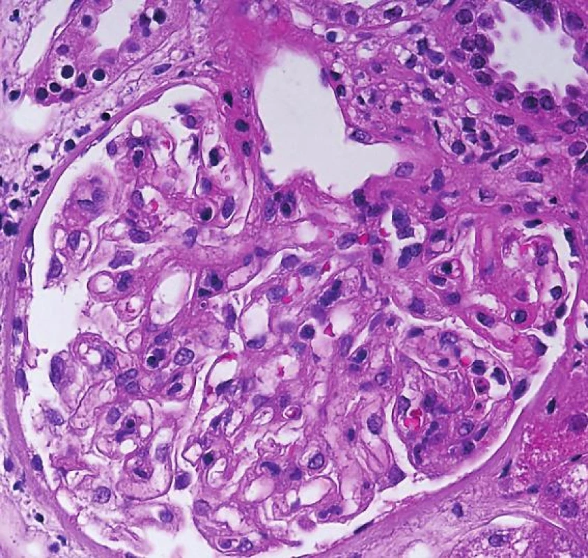 IgA-dominantní postinfekční GN. Glomerulus s akcentovaným mesangiem
a segmentální endokapilární proliferací (šipky, objektiv 40x, HE).