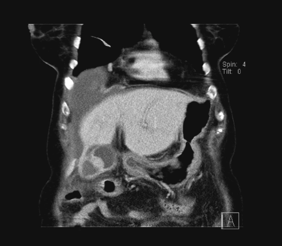 Předoperační CT, koronální řez
Fig. 1. Preoperative CT, coronary section