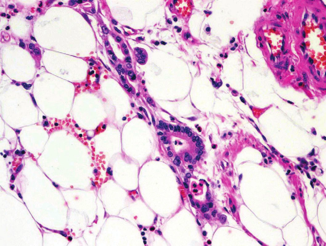 Pankreatický duktální adenokarcinom (PDA). Solitární glandulární formace PDA v tukové tkáni bez vazby na ostatní pankreatické struktury či fibrózu. Barveno hematoxylinem eozinem (zvětšení 200x).