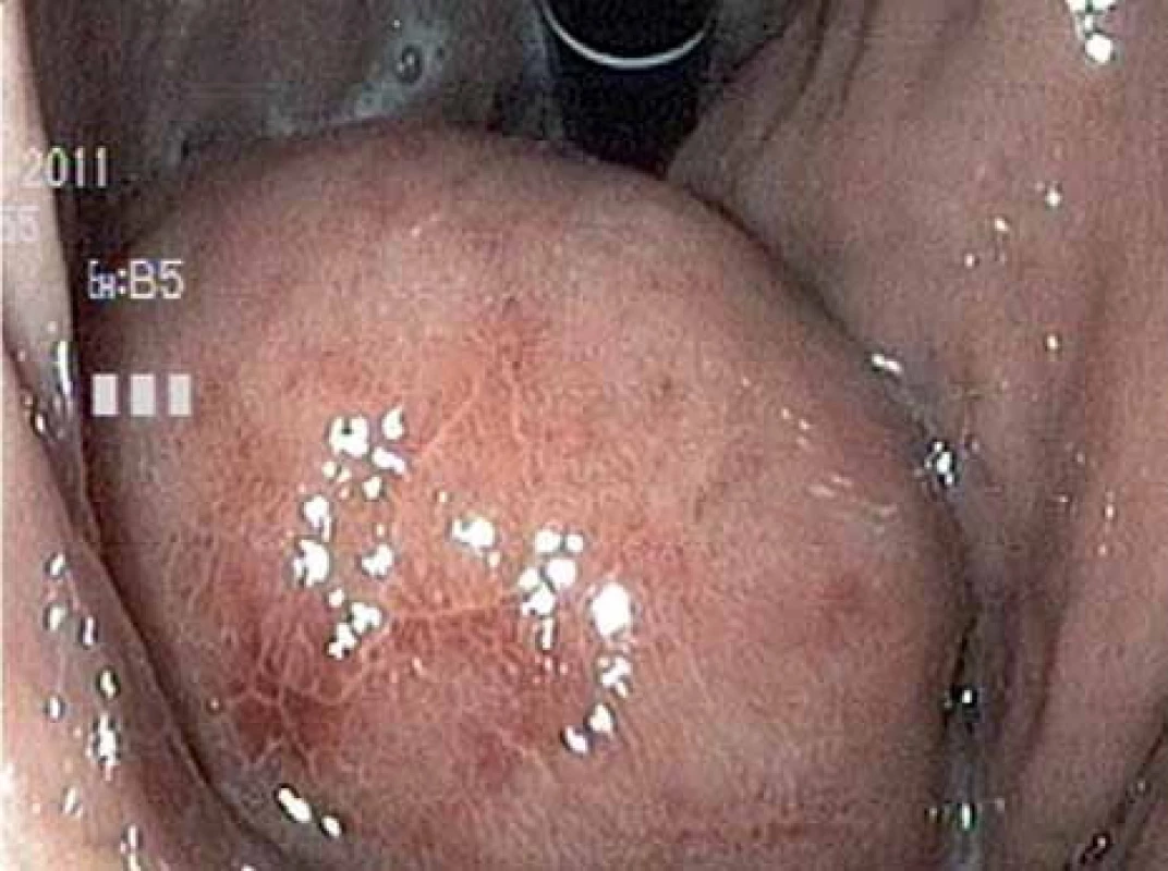 Subepiteliální nádor žaludku subkardiálně (gastroskopie).