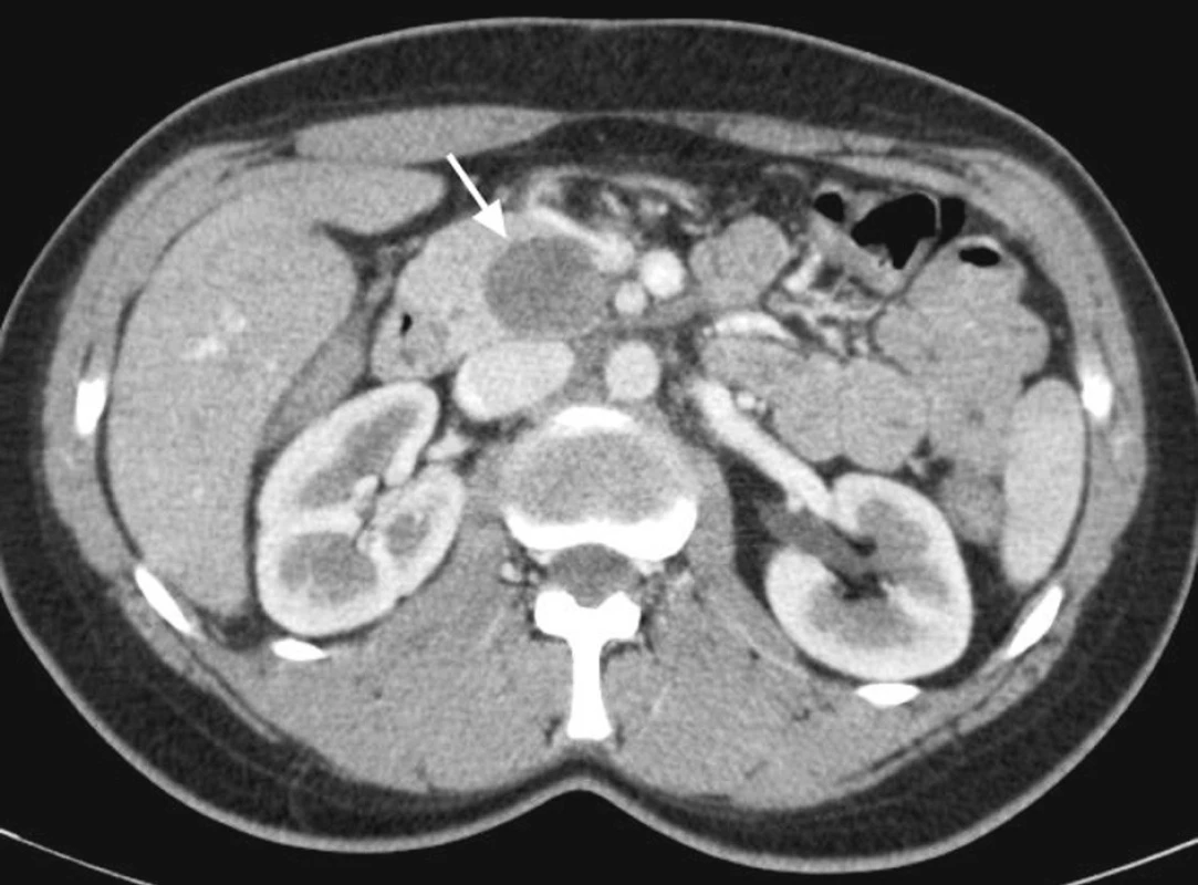 CT vyšetření pankreatu s bolusem kontrastní látky intravenózně v arteriální fázi. V processus uncinatus je patrná dobře ohraničená tumorózní expanze
Pic. 1. CT scan with arterial phase enhancement shows well defined tumorous expansion in the uncinate process of pancreas