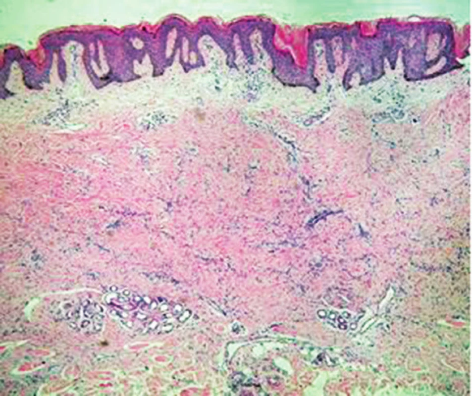 Pod hyperplastickou, hyperpigmentovanou epidermis je v retikulárním koriu patrný málo buněčný fibrózní tumor sahající k potním žlázám (HE, zvětšení 40x)