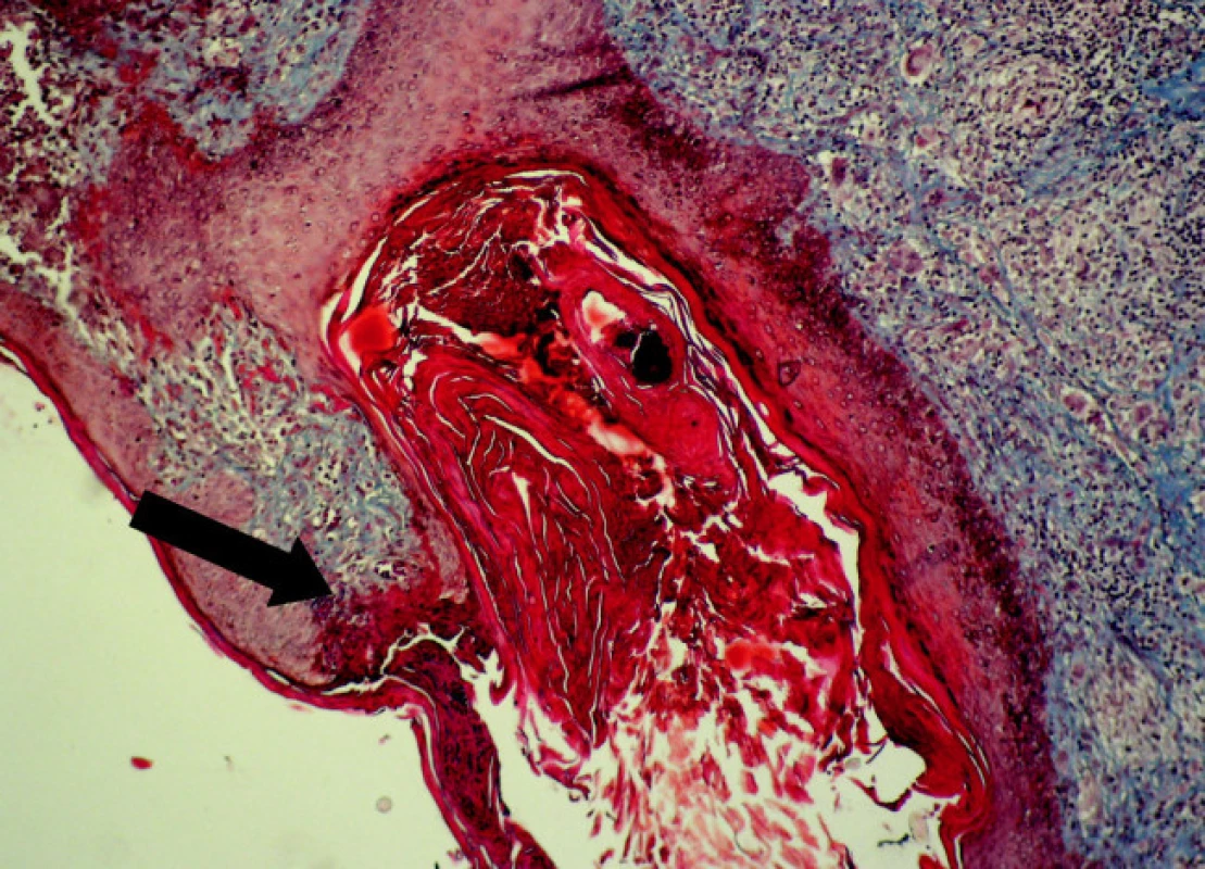 Výrazne dilatovaný folikul s nepravidelným epitelom. Perforácia hornej infundibulárnej časti folikulu /šípka/. Ústie je vyplnené orto- aj parakeratotickým keratínom a celulárnou debris. Na povrchu ruptovaného epitelu je parakeratotická „zátka“.V okolí je chronický zápalový infiltrát s obrovskobunkovou reakciou v derme (Massonov trichróm, 120-krát)
