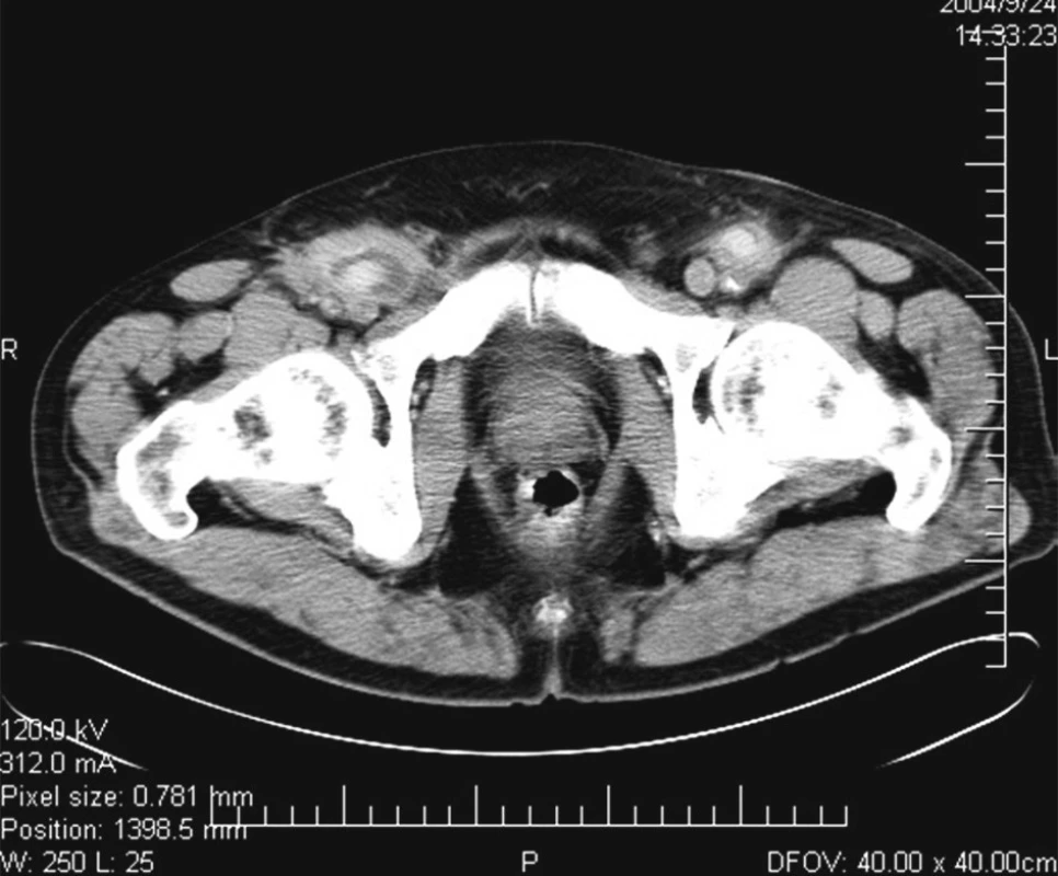 CT angiografie zobrazující infiltráty kolem cévních protéz v obou tříslech
Fig. 3. CT angiography showing bilateral periprosthetic infiltrates in the groin