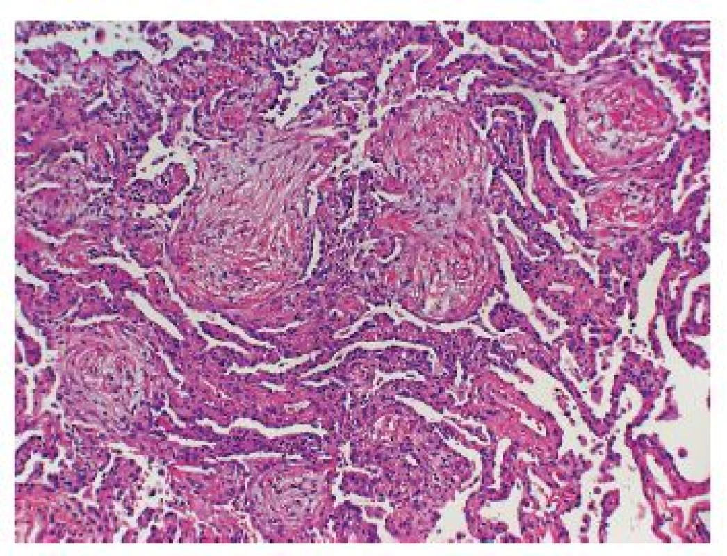 Organizující (se) pneumonie s přítomností polyploidních nahromadění granulační tkáně tzv. Massonovových tělísek