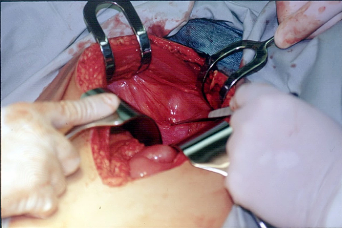 Poranění močového měchýře – perforační otvor v peritoneu nad močovým měchýřem