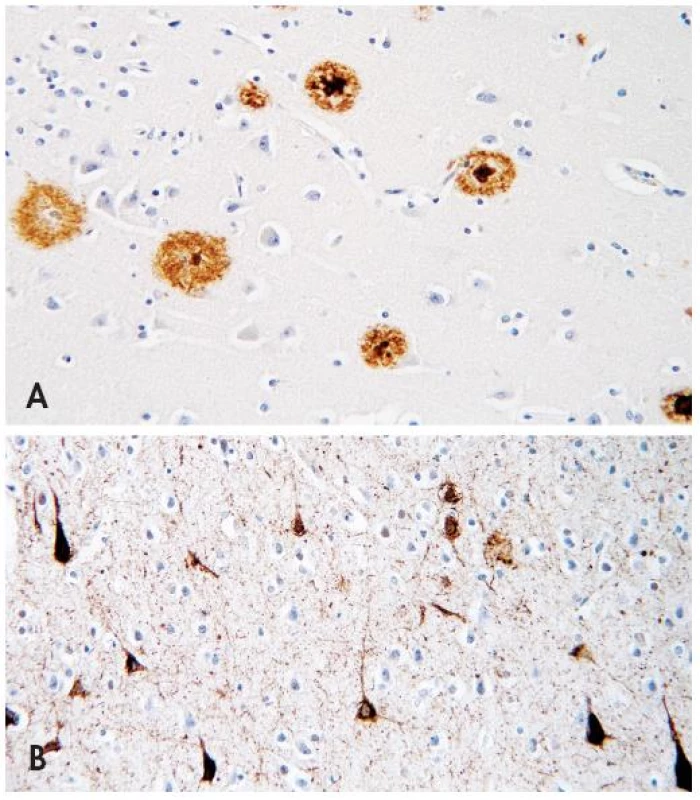 Neuropatologické markery Alzheimerovy nemoci. (A) Amyloidové senilní plaky různých typů ve frontálním kortexu pozitivní v imunohistochemické reakci s monoklonální protilátkou proti amyloid-ß-proteinu u Alzheimerovy nemoci. Původní zvětšení 400x. (B) Neurofibrilární klubka (tangles) v hipokampální formaci pozitivní v imunohistochemické reakci s monoklonální protilátkou proti hyperfosforylované formě tau proteinu (klon AT8) Alzheimerovy nemoci. Původní zvětšení 400x.