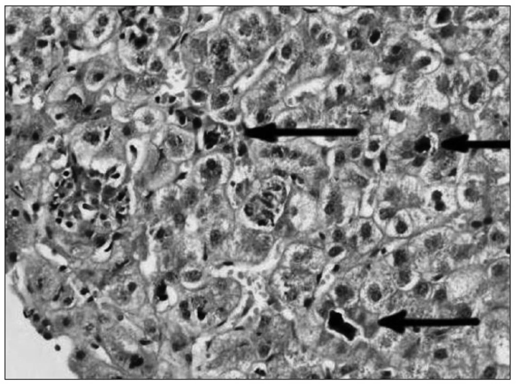 Cholestáza – akumulácia žlčového pigmentu v pečeni (HE, 40x).
Fig. 3. Cholestasis – accumulation of bile pigment in hepatocytes (HE, 40x).