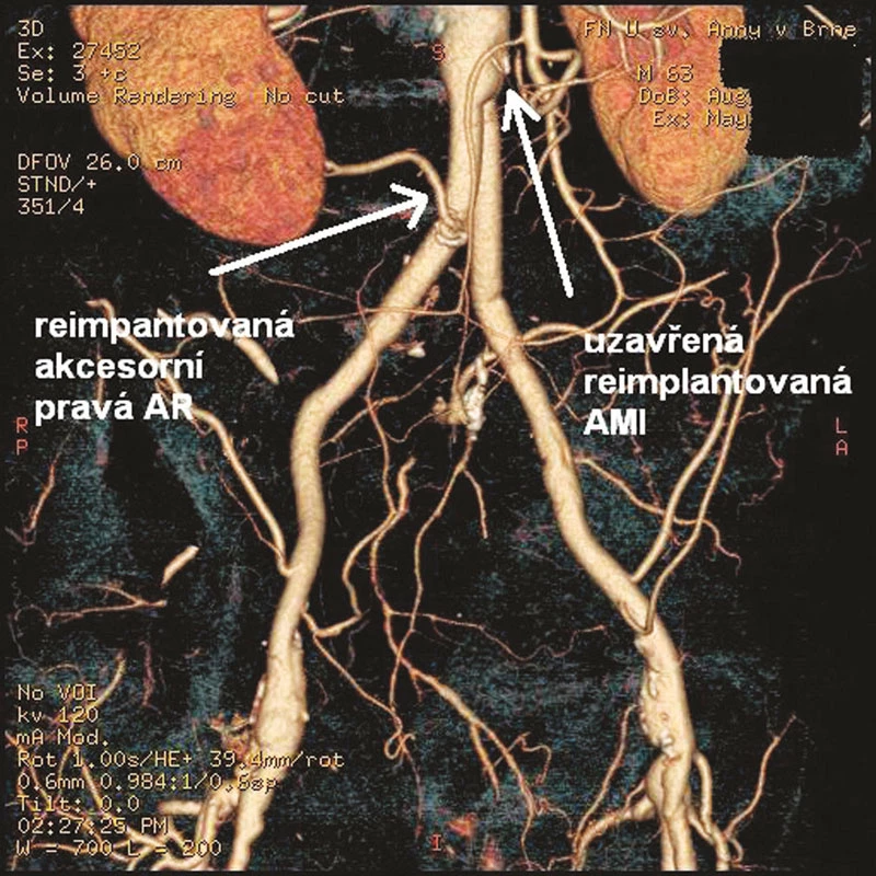 Pooperační rekonstrukce CTA s nálezem průchodné reimplantované akcesorní AR a uzavřené AMI
Fig. 3: Postoperative CTA with patent reimplanted accessory right renal artery (AR) and occluded reimplanted inferior mesenteric artery (AMI)