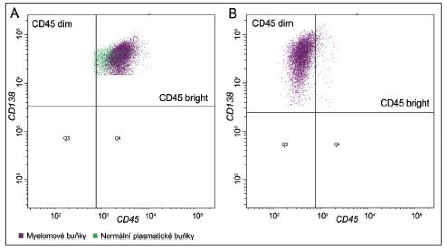 Vyšetření průtokovou cytometrií, exprese CD45 u plazmocytů
Obr. 1A Populace patologických plazmatických buněk s vyšší „bright“ expresí znaku CD45 (fialové- plasmatické buňky, zeleně lymfocyty) „bright“ skupina. 
1B Populace plazmocytů s nižší „dim“ expresí CD45 znaku –„dim“ skupina.