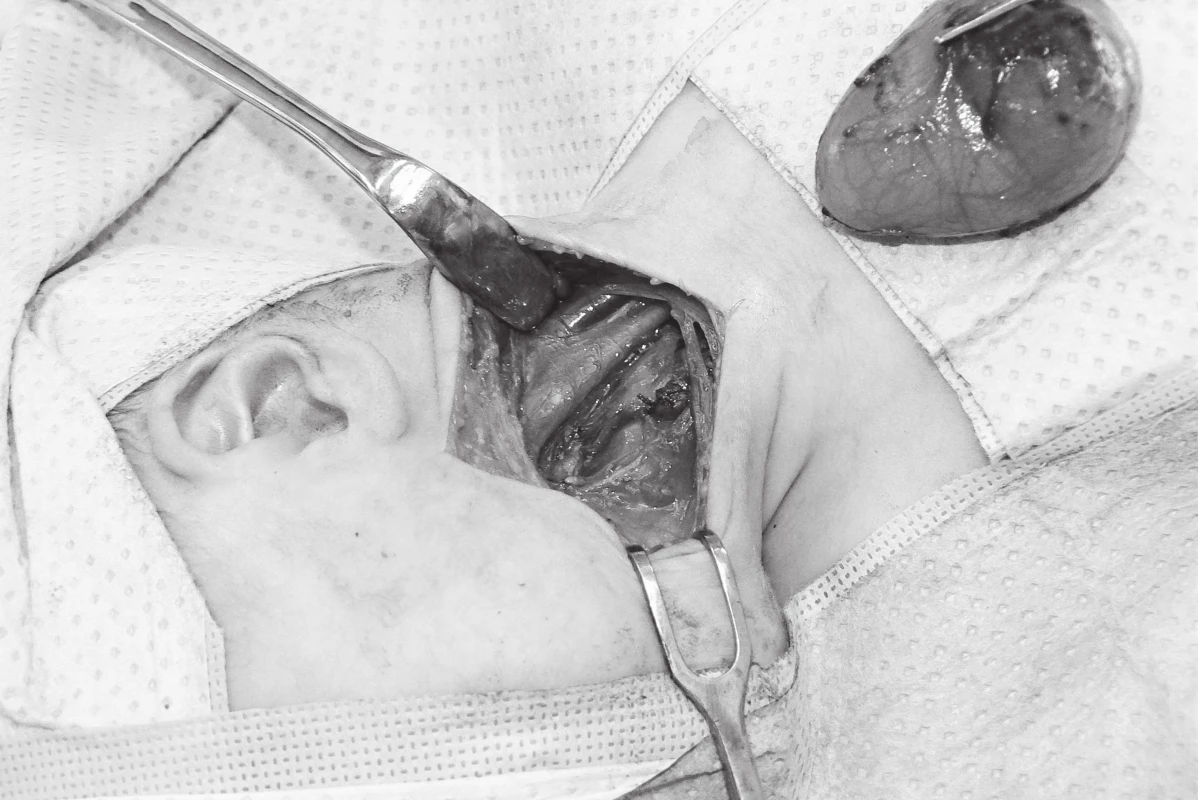 Operační pole po chirurgické exstirpaci cysty.
Fig. 2. Surgical extirpation of the cyst.