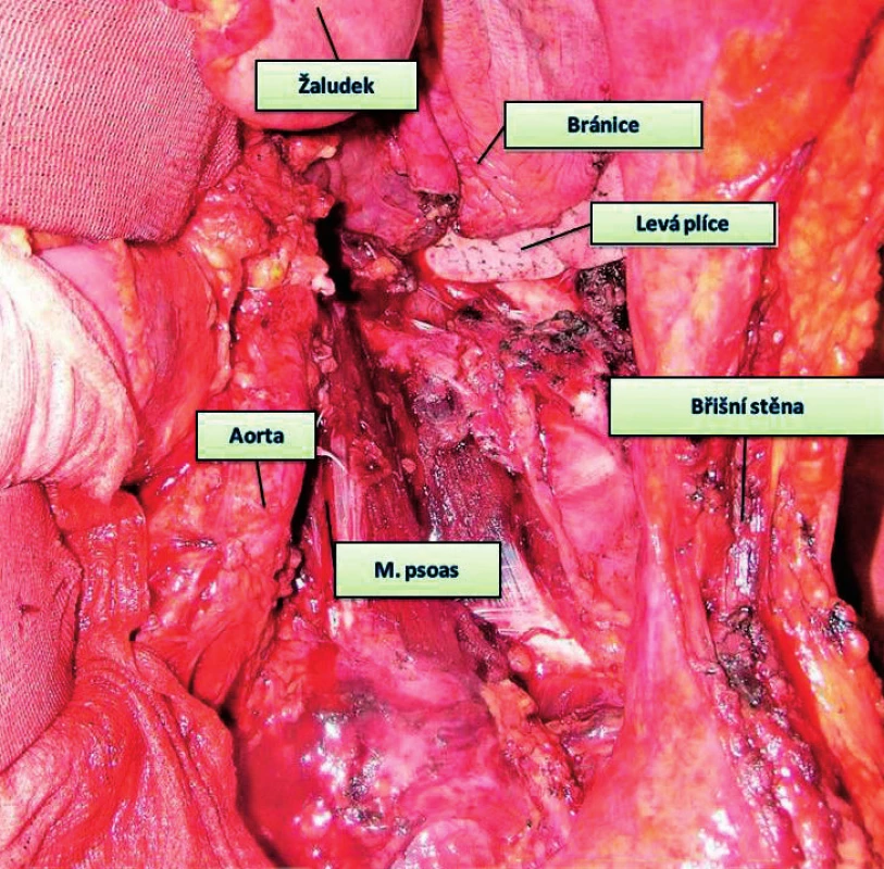 Stav po resekci výše zobrazeného karcinomu – multiorgánová resekce
