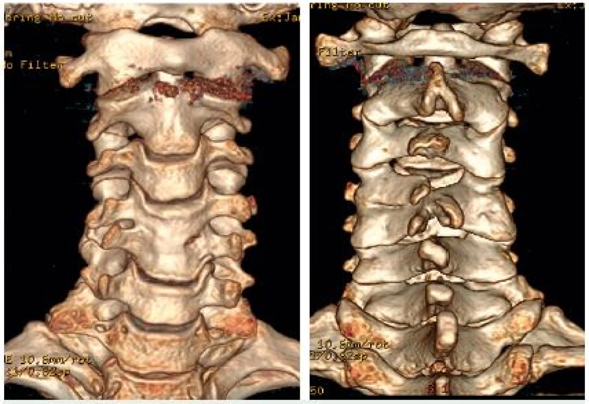 3D CT vyšetrenie C chrbtice - kongenitálna synostóza C4 a C5, koronárna rovina A - z predu, B - zo zadu.