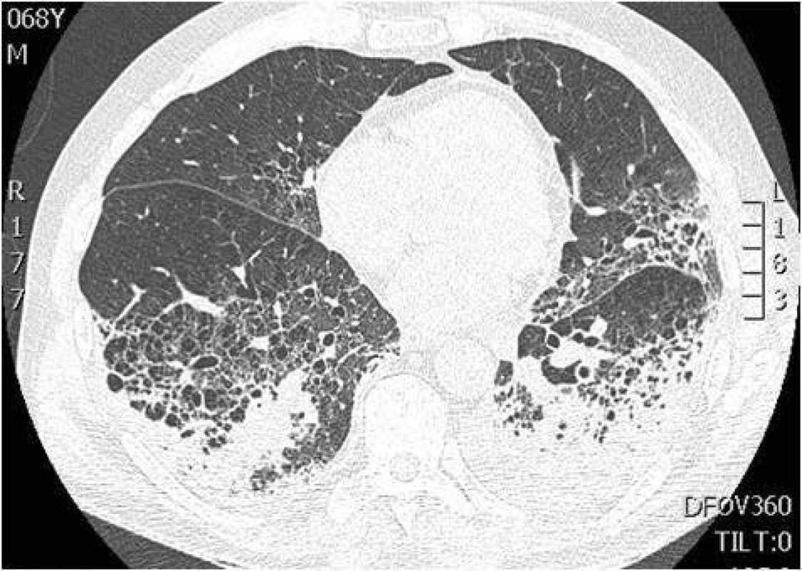 CT hrudníku – pneumonie