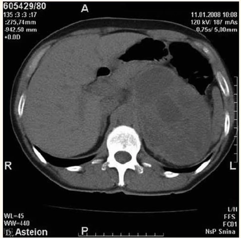 CT scan zobrazujúci veľký tumorózny útvar v oblasti ľavej nadobličky s nehomogénnou, prevažne vyššou denzitou a ložiskami nekrózy vnútri tumoru (histologicky feochromocytóm).