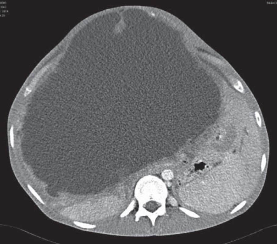 CT abdomenu pri recidíve v roku 2014 (viditená rozsiahla cystická lézia s vyklenovaním brušnej dutiny).
Fig. 1. CT of the abdomen during a relapse in 2014 (visible extensive cystic lesion with a domed abdomen).