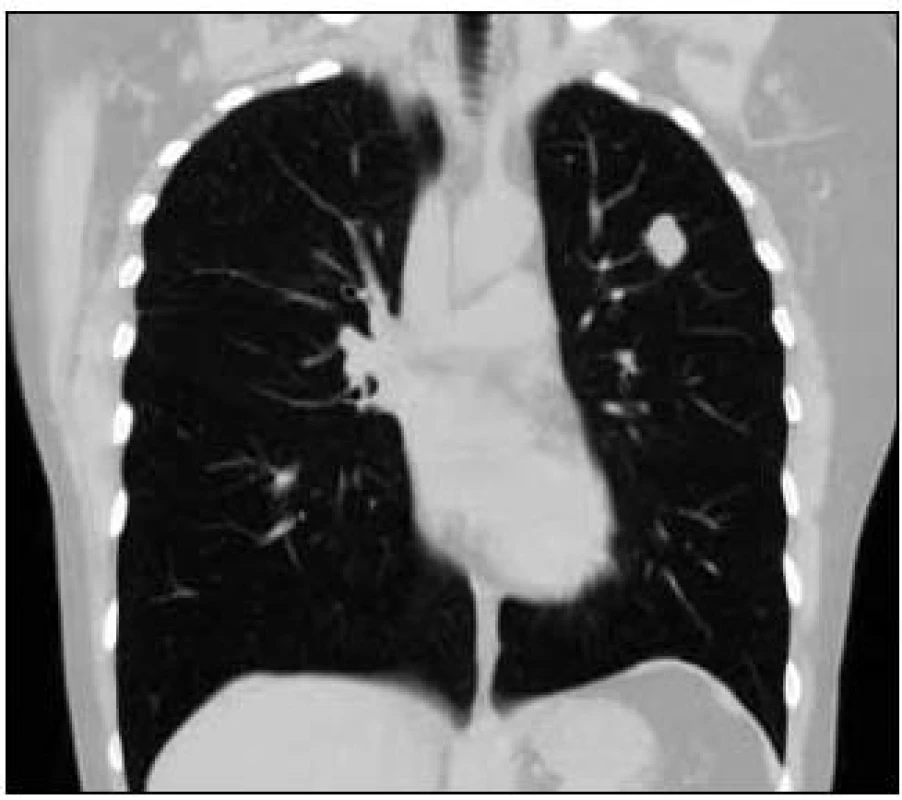 Vstupní vyšetření, CT obraz plic, stejné ložisko v „plicním okně“ v koronárním řezu.
