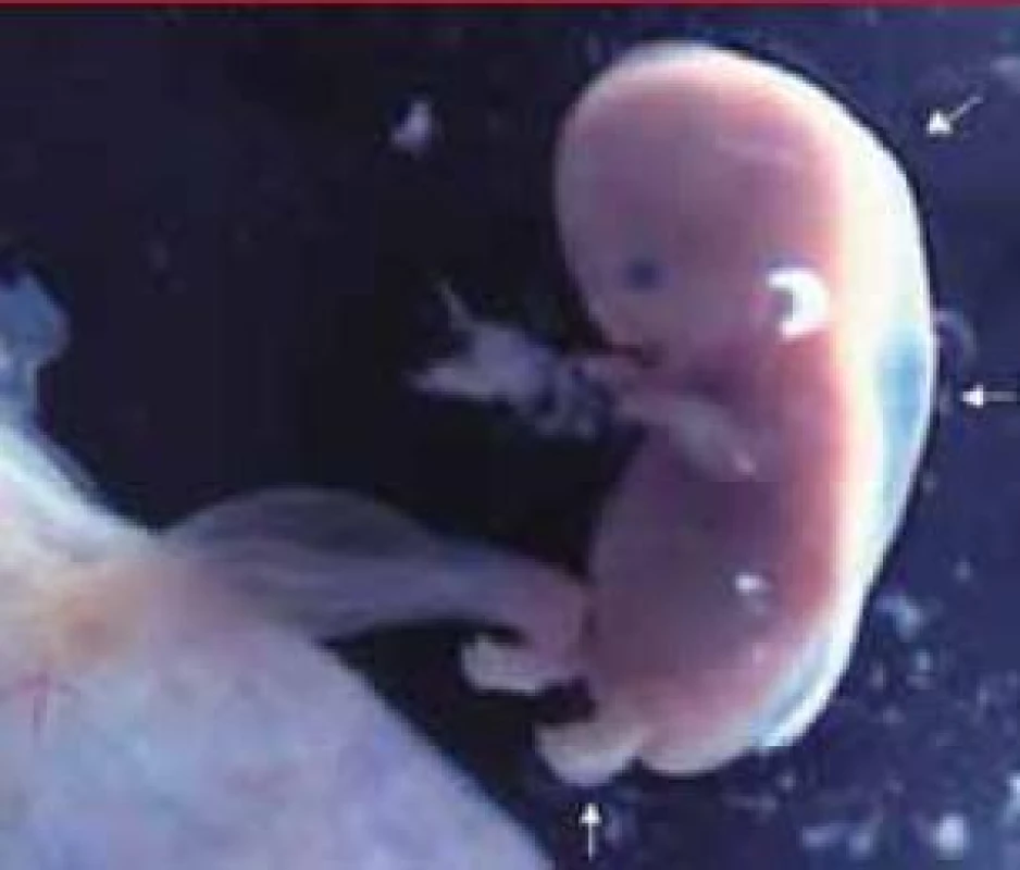 Rozsiahly hygróm krku a edém ľavej dolnej končatiny (šipky) u embrya v 7. vývojovom týždni. Dobre viditeľné tri umbilikálne cievy.