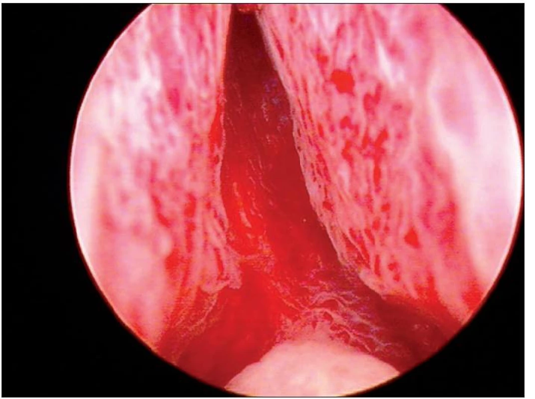 Endoskopický pohled – prostatická uretra před začátkem výkonu