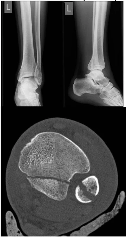 –9: Úrazové RTG snímky šikmé zlomeniny fibuly a odlomené zadní hrany tibie zaujímající přibližně 25 % kloubní plochy a CT snímek poukazuje na rošířenou TF syndesmózu