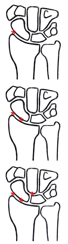 a) SLAC I: artrotické změny v oblasti mezi skafoideem a styloideálním výběžkem vřetenní kosti.
b) SLAC II: artrotické změny v oblasti celého radioskafoideálního skloubení.
c) SLAC III: radioskafoideální artróza spolu s postižením lunokapitátního skloubení.