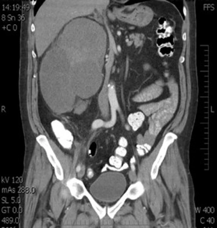 CT snímek tumoru
Fig. 1. CT of tumor