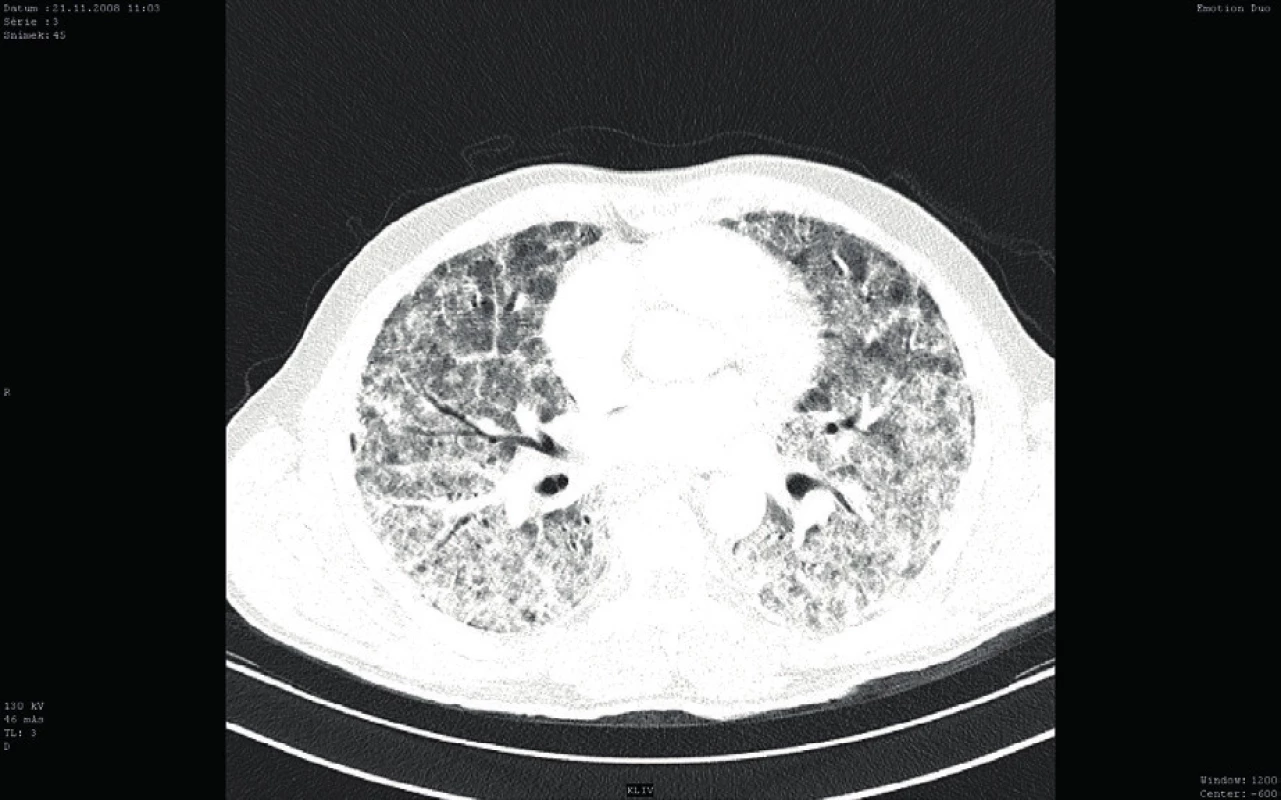 Vstupní CT vyšetření plic