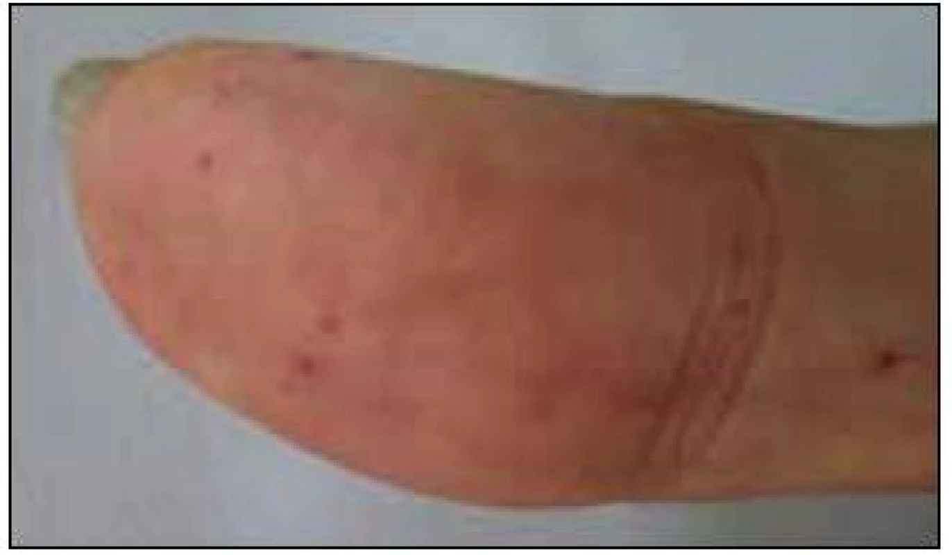 Prst pacientky s typickými kožními teleangiektaziemi.