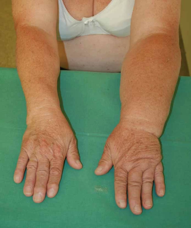 Lymfedém levé horní končetiny s maximem postižení v oblasti ruky a předloktí (2. stadium) 2 roky po parciální mastektomii s disekcí axily.