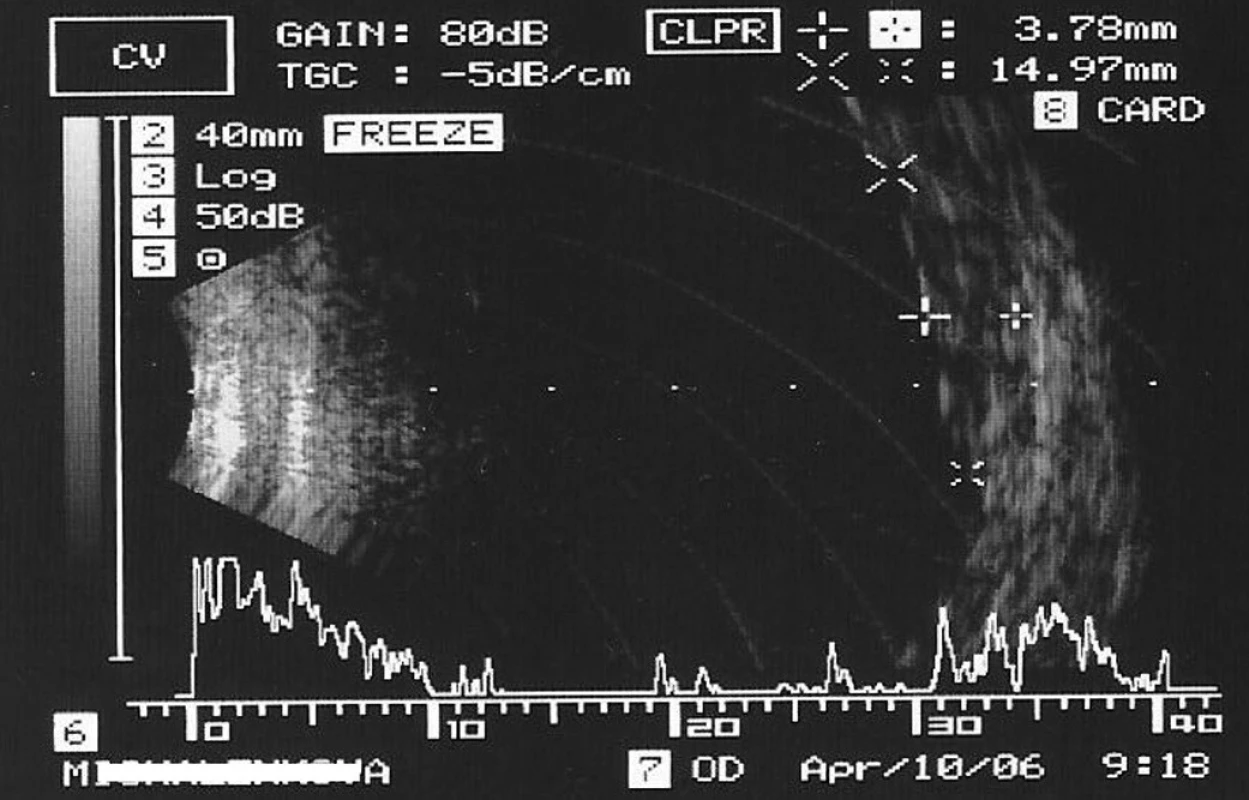Ultrazvukový záznam – Bscan – obraz reziduálneho ložiska pod silikónovým olejom v hrúbke do 3,8 mm viac ako 1 rok po endoresekcii (v r. 2006)
