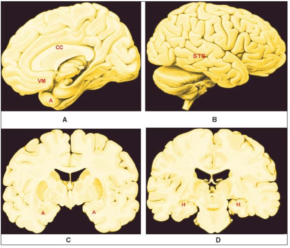 A – D.
Přibližná poloha oblastí mozku, jejichž strukturální a funkční odchylky korelují psychopatii
Legenda:
A – Vnitřní plocha pravé hemisféry;
B – Zevní plocha pravé hemisféry;
C – Řez v čelní rovině na úrovni amygdaly;
D – Řez v čelní rovina na úrovni s. nigra;
CC – corpus callosum;
VM – ventromediální prefrontální kůra;
A – amygdala;
STS – kůra sulcus temporalis superior;
H – hipokampus;