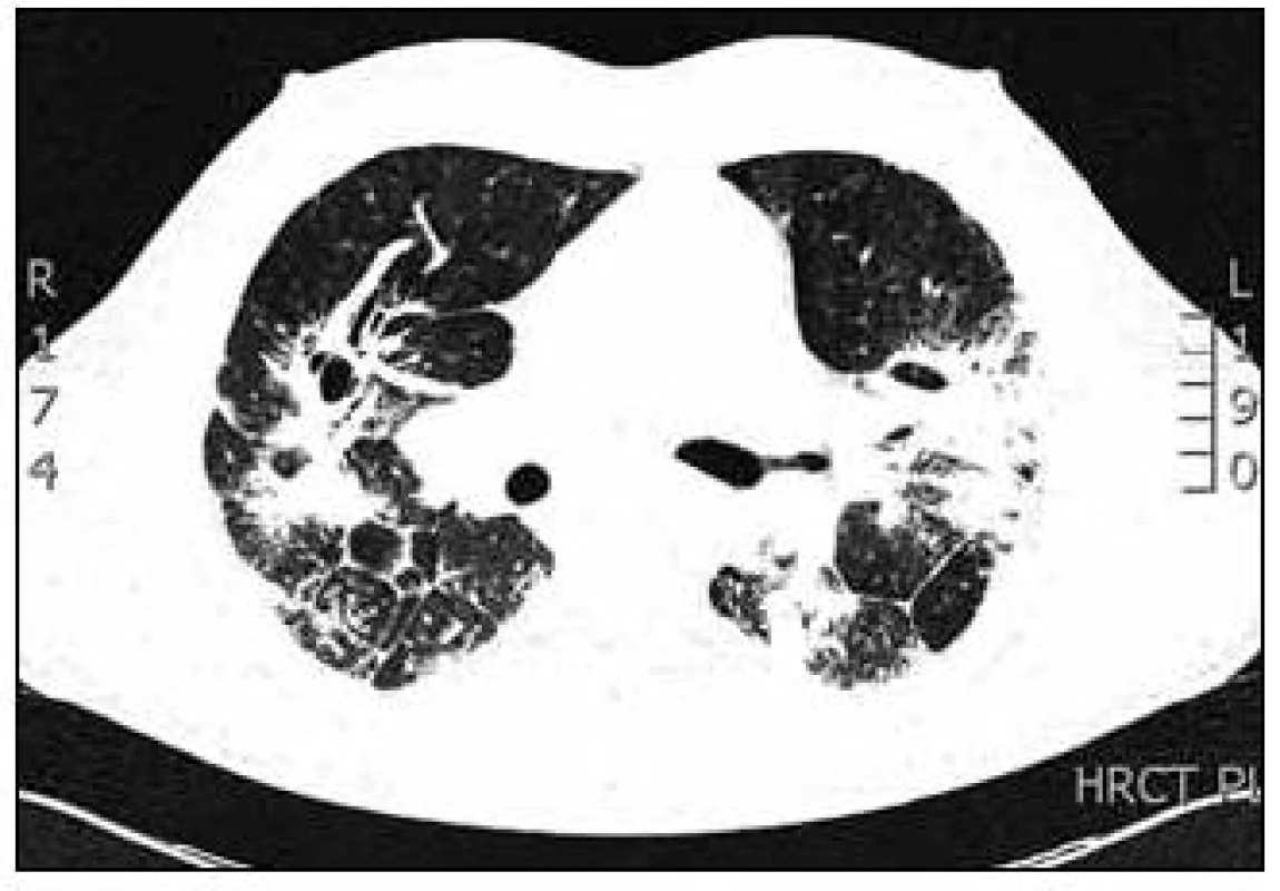 HRCT hrudníku (výpočetní tomografie s vysokou rozlišovací schopností) v době diagnózy.