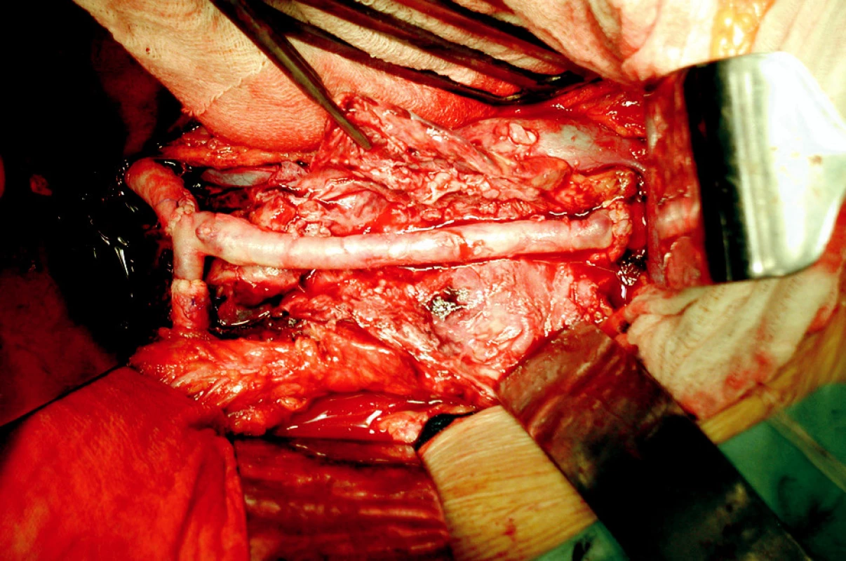 Aorto-biiliakální rekonstrukce autologní vénou femoralis superficialis
Fig. 4. Aorto-biiliac reconstruction by an autologous superficial femoral vein graft