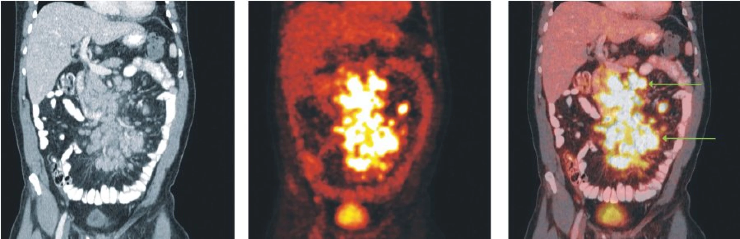Snímky výpočetní tomografie (CT), pozitronové emisní tomografie (PET) a PET/CT u nemocného s difuzním B-velkobuněčným lymfomem. Mnohočetné zvětšené lymfatické uzliny v mezenteriu vykazují hypermetabolismus glukózy.