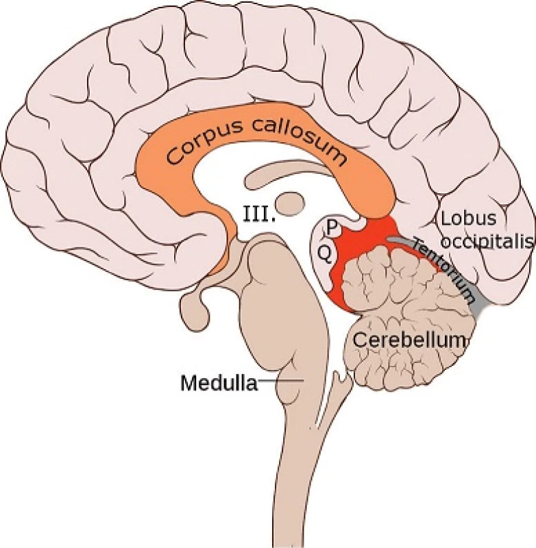 Sagitální řez mozkem:
Anatomický pohled na struktury v blízkosti pineální krajiny (červeně). Zobrazena mj. třetí mozková komora (III.), pineální žláza (P), lamina quadrigemina (Q).
Upraveno dle „Brain bulbar region” autorů Patrick J. Lynch a C. Carl Jaffe, použito na základě CC BY 2.5.
Fig. 1: Sagittal section of the brain:
An anatomical view of the pineal region (in red) and adjacent structures. The third ventricle (III.), the pineal gland (P) and lamina qudrigemina (Q) are depicted.
Adapted from &quot;Skull and brain sagittal&quot; by Patrick J. Lynch and C. Carl Jaffe; used under CC BY 2.5.
