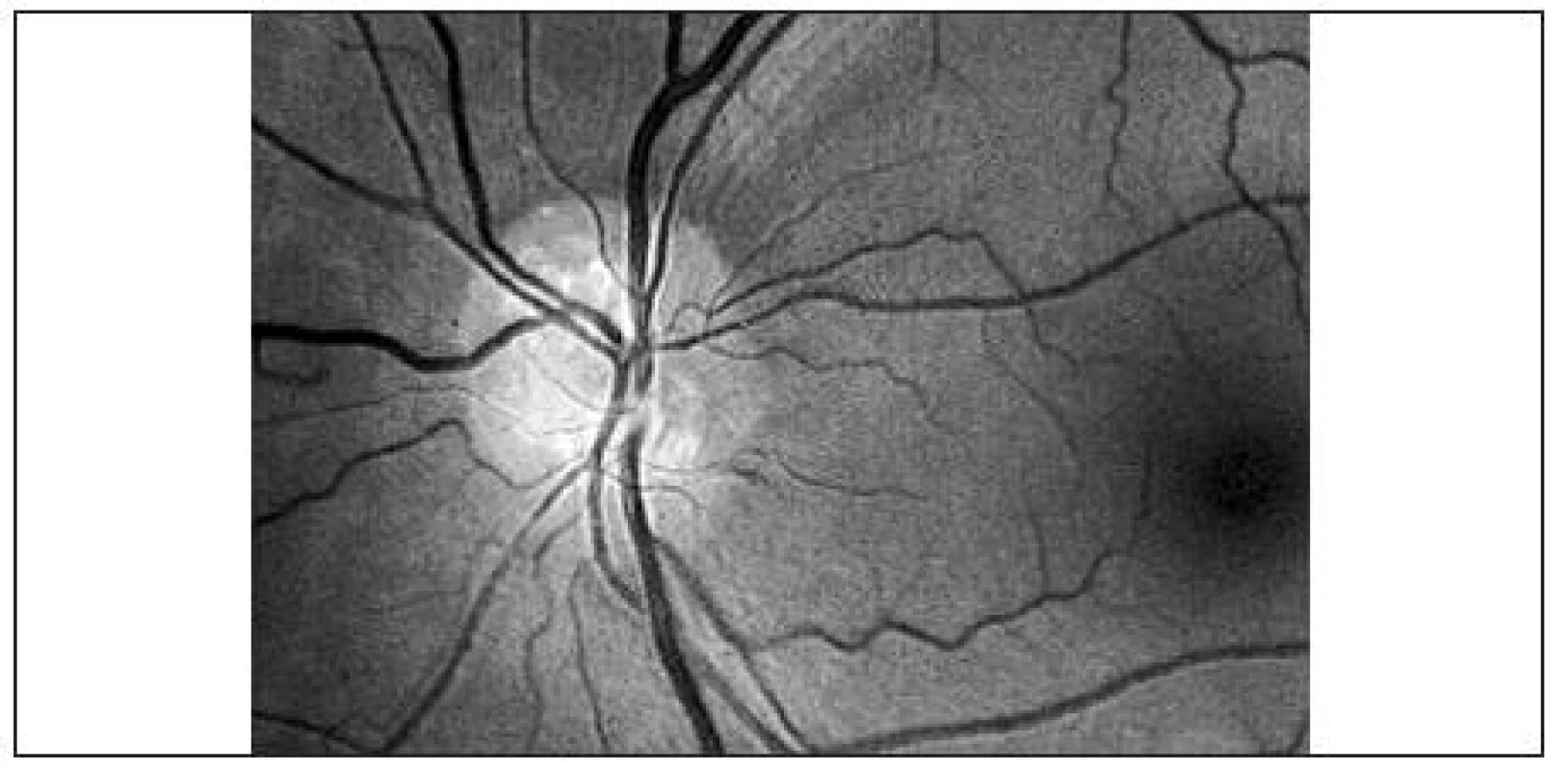 Povrchovo lokalizované drúzy zrakového nervu ľavého oka, dobre viditeľné na red free fotografii
