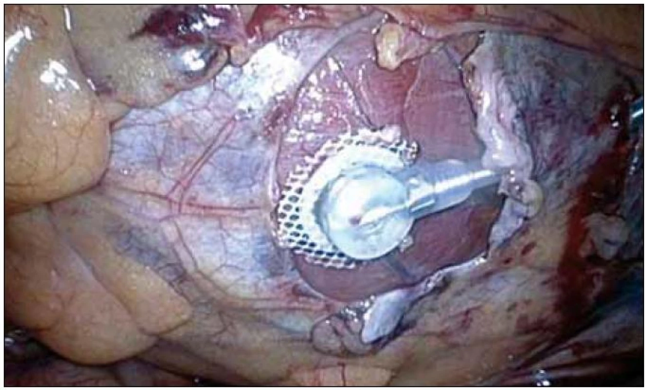 Torakoskopicky implantovaná ľavokomorová epikardiálna elektróda.