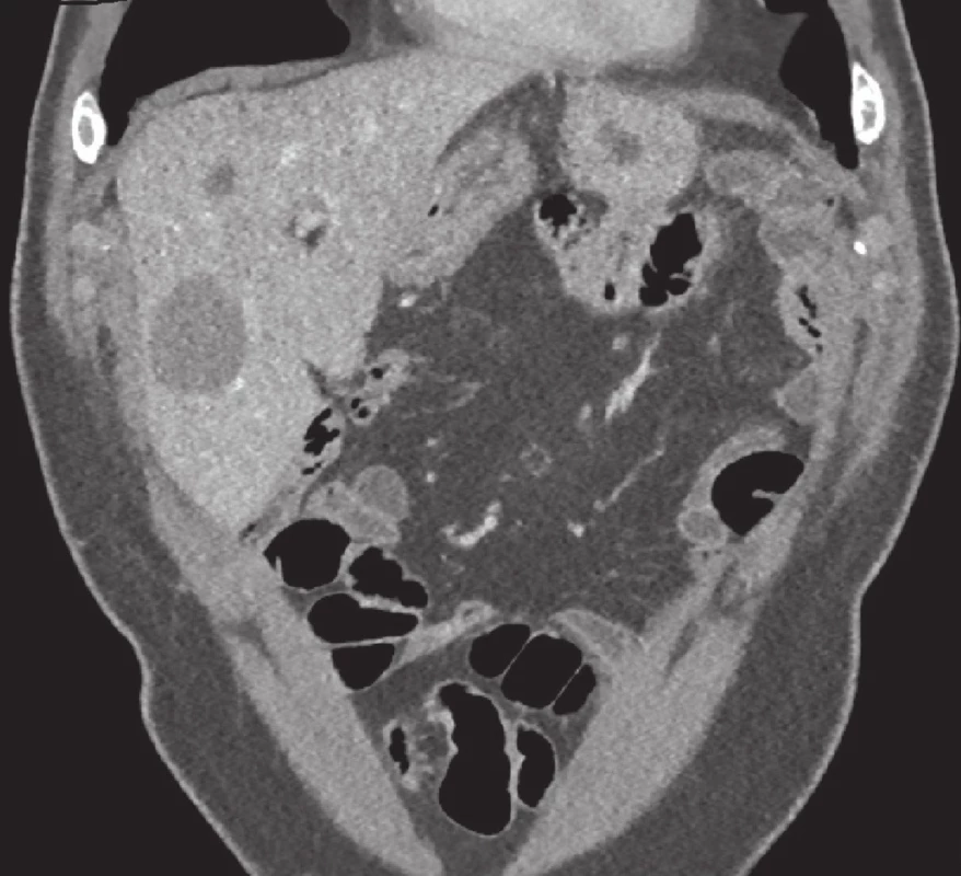 Ložiska jater nejasné etiologie
Fig. 7: Liver tumors of unclear etiology